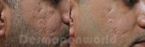 mezoterapia igłowa przed i po zdjęcia